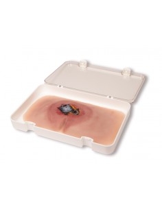 Moulage di ulcera da...