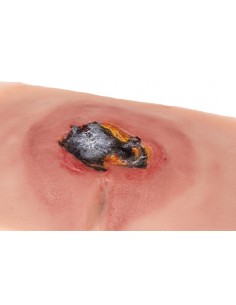 Moulage di ulcera da... 2