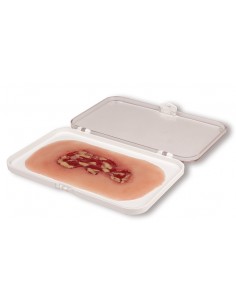 Moulage di ulcera venosa...