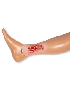 Moulage di ulcera venosa... 2