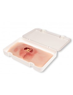 Moulage di ulcera da...