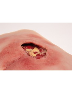 Moulage di ulcera da... 2