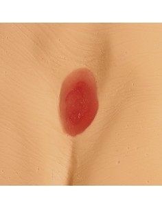 Modelli di ulcere da... 2