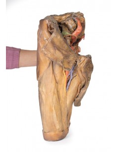 Dissezione di emipelvi e... 2