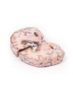 Glioma di grado 3-4, che ha... 2