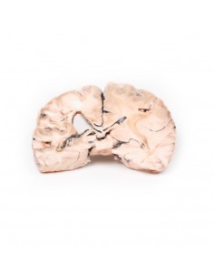 Infarto cerebrale sinistro...