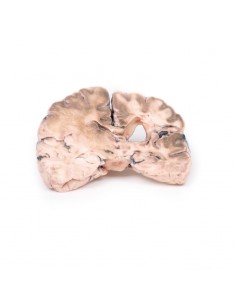 Infarto cerebrale sinistro... 2