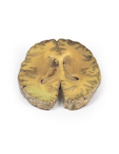 Ventricolite, secondaria a... 2