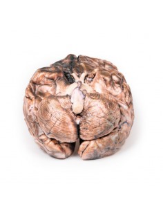 Aneurisma sacculare - Erler...