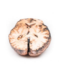 Aneurisma sacculare - Erler... 2