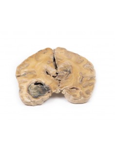 Glioblastoma multiforme -...