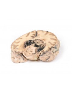 Glioblastoma multiforme -...