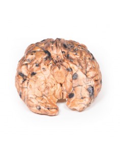 Melanoma metastatico -...