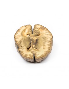 Carcinoma metastatico nel... 2