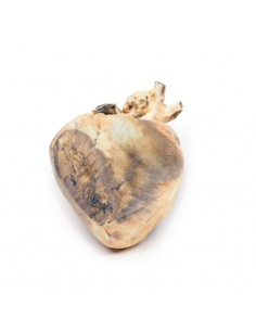 Difetto interatriale -...