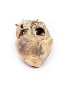 Difetto interatriale -... 2