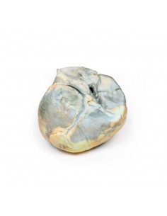 Ipertrofia ventricolare...