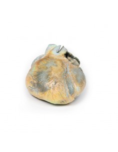 Ipertrofia ventricolare... 2