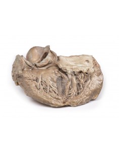 Valvola aortica bicuspide -...