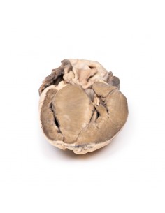 Stenosi subaortica... 2