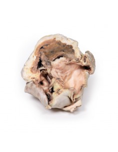 Stenosi valvolare aortica... 2