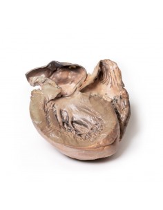 Aneurisma dell'aorta...