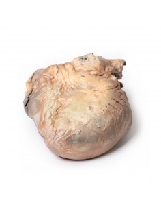 Aneurisma dell'aorta... 2