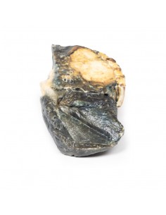 Tumore metastatico nel... 2