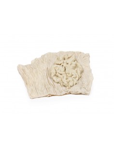 Adenoma villoso del colon -...