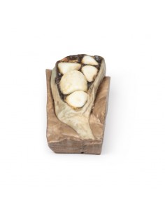 Colelitiasi (calcoli...