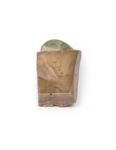 Colelitiasi (calcoli... 2