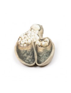 Colecistite e colelitiasi -...