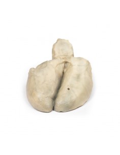 Colecistite e colelitiasi -... 2