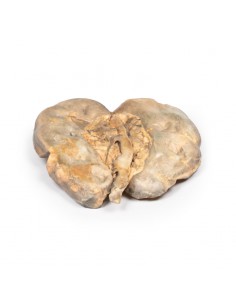 Idronefrosi e idrouretere... 2