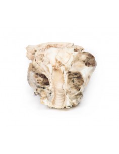 Gozzo multinodulare - Erler...