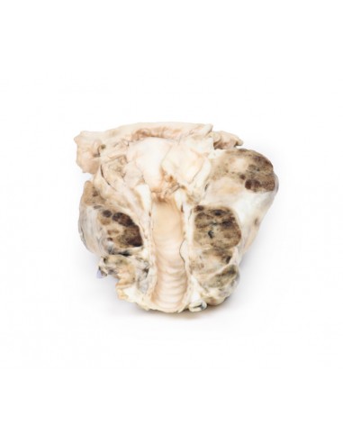 Gozzo multinodulare - Erler Zimmer 3D... Gozzo multinodulare - Erler Zimmer 3D...