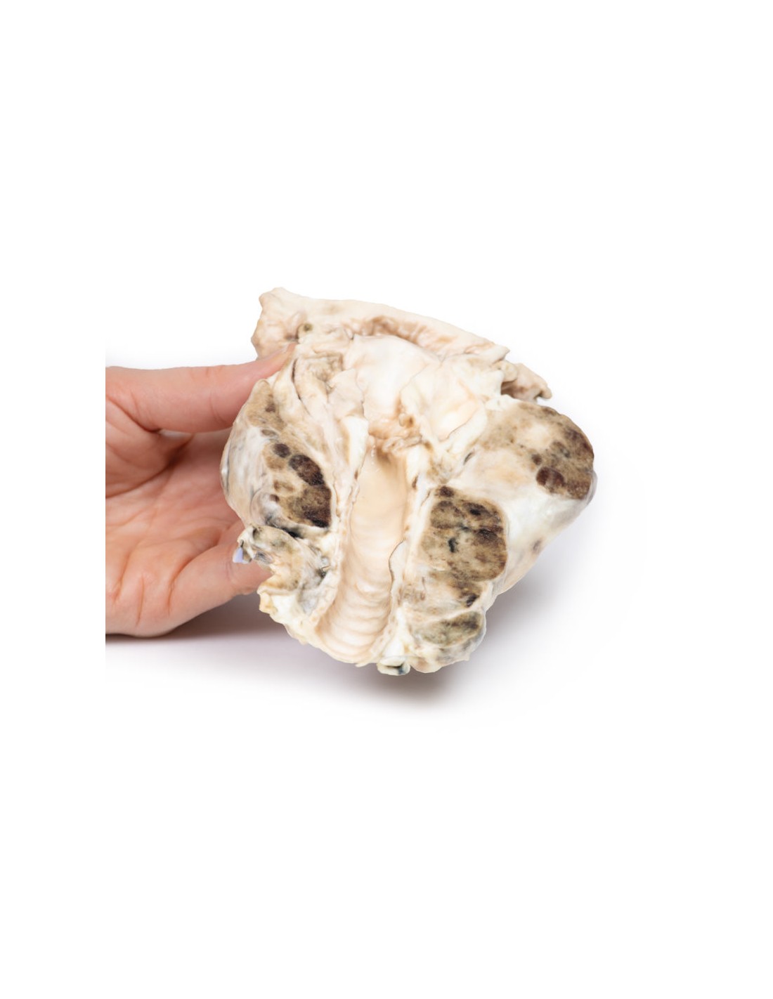 Gozzo multinodulare - Erler Zimmer 3D... Gozzo multinodulare - Erler Zimmer 3D...