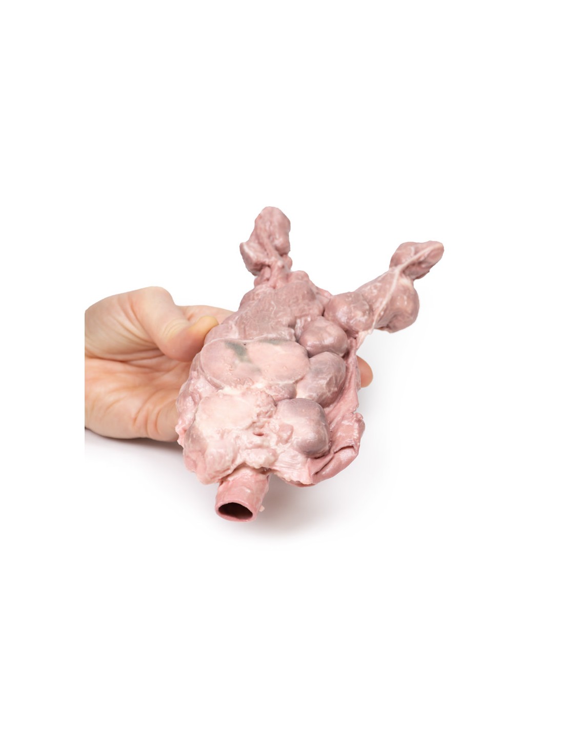 Linfonodi aortici e para-aortici -... Linfonodi aortici e para-aortici -...