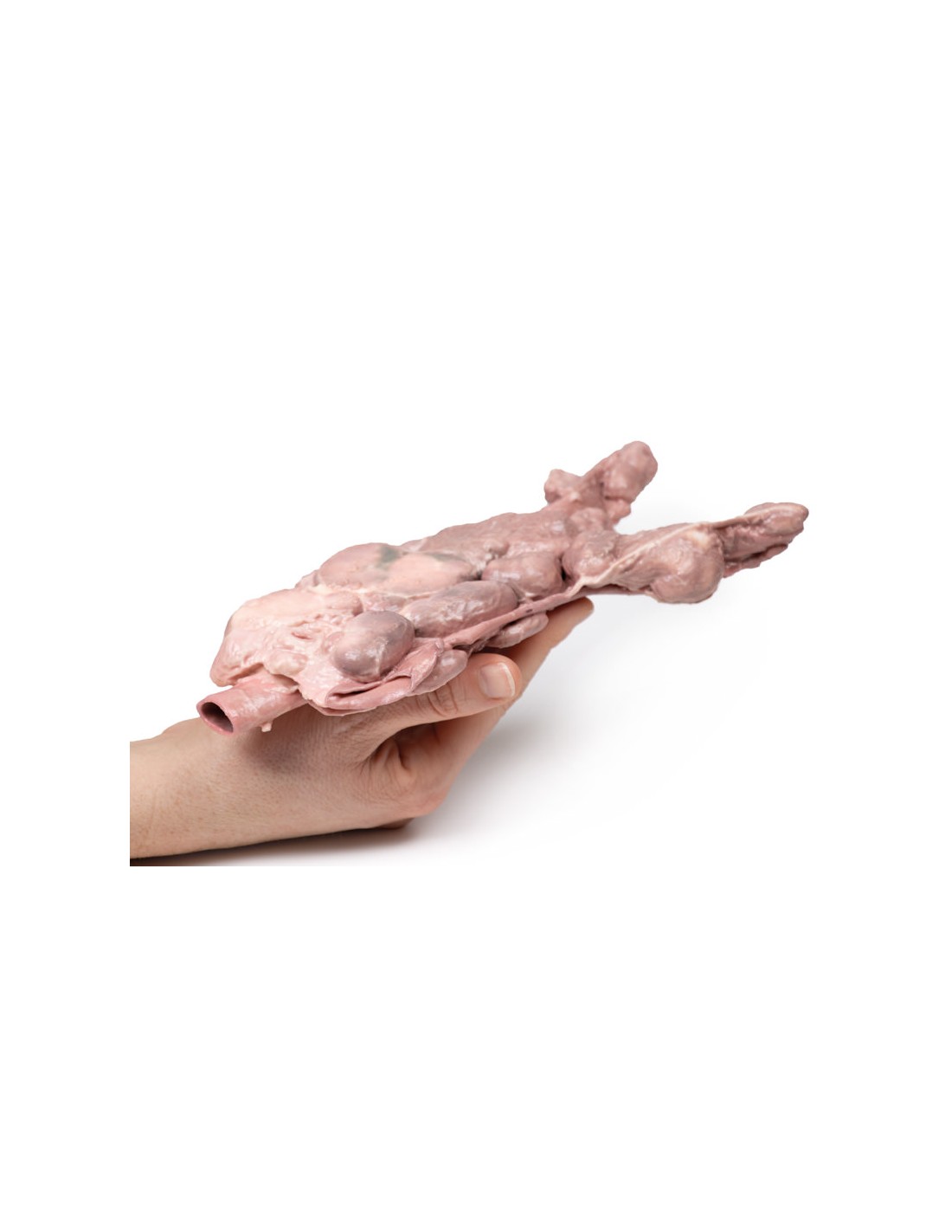 Linfonodi aortici e para-aortici -... Linfonodi aortici e para-aortici -...