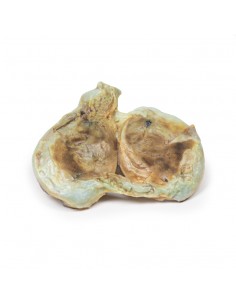 Idrocele cronico - Erler... 2