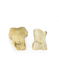 Osteocondroma - Erler... 2