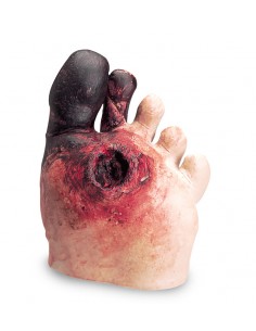 Piede diabetico Erler...