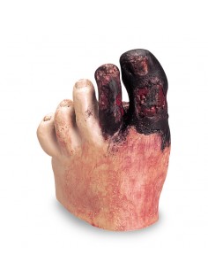 Piede diabetico Erler... 2